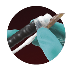 Removal of the Barrett's epithelium with Focal Radio Frequency Ablation