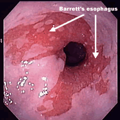 Barrett's Oesophagus