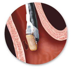 ABLATION USING THE HALO 90 SYSTEM