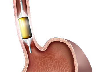 Removal of the Barrett's epithelium with Circumfrential Radio Frequency Ablation