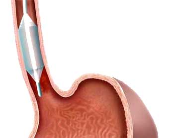 Removal of the Barrett's epithelium with Circumfrential Radio Frequency Ablation